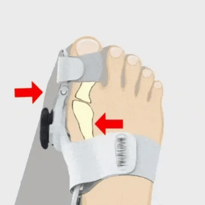Bunion fix